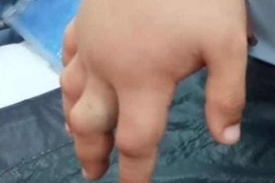 Un niño fue mordido por una yarará en la Costanera santafesina
