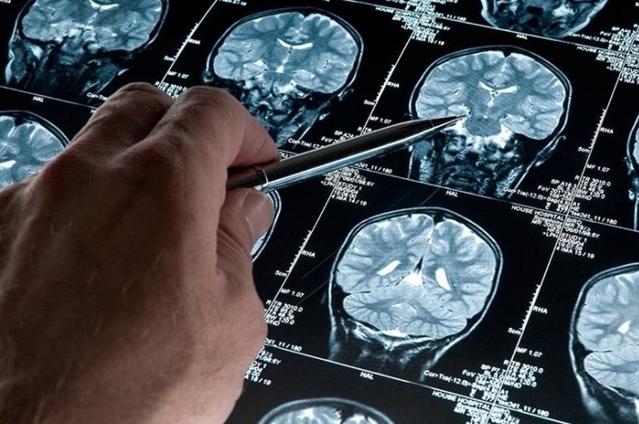 EEUU aprobó el primer medicamento para atacar el Alzheimer