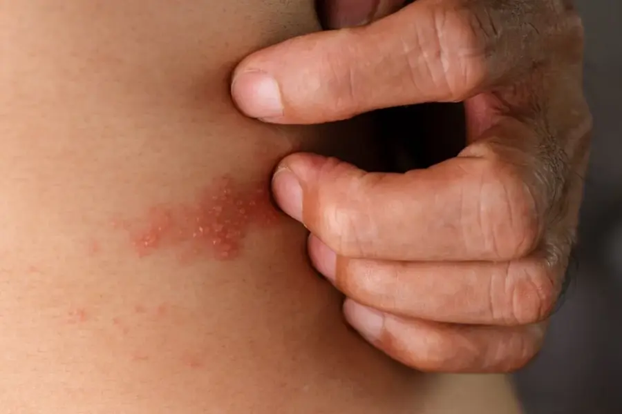 San Lorenzo: descartaron ébola en un tripulante embarcado y confirmaron que su diagnóstico es herpes zóster